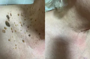 Bee Venom Mole and Wart Treatment Cream 🐝(AAD Recommended) photo review